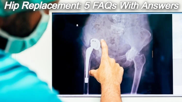 Hip Replacement: 5 FAQs with Answers